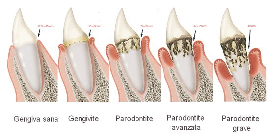 parodontite
